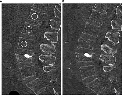 Opportunistic QCT Bone Mineral Density Measurements Predicting Osteoporotic Fractures: A Use Case in a Prospective Clinical Cohort